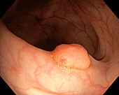 Colon polyp, endoscope view