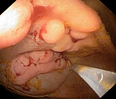 Colon polyp surgery, endoscope view