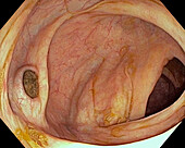 Diverticulosis of the colon with stercolith, endoscope view