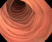 Descending colon, endoscope view