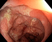 Colon in ulcerative colitis, endoscope view