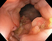 Rectal cancer, endoscope view