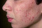 Acne vulgaris