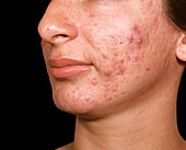 Acne vulgaris