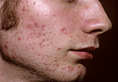 Acne vulgaris