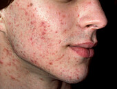 Acne vulgaris