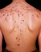 Acne vulgaris
