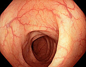 Normal colon, endoscope view