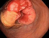 Rectal cancer, adenocarcinoma, endoscope view