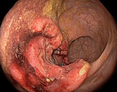 Rectal cancer, adenocarcinoma, endoscope view