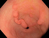 Antral gastritis, endoscope view