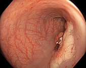 Intestinal polyps, colonoscopy view