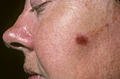 Lever's facial granuloma