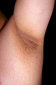 Acanthosis nigricans