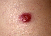 Merkel cell carcinoma