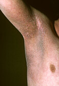 Parapsoriasis lichenoides skin lesion
