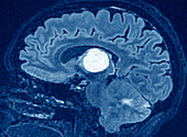 Secondary brain cancer, MRI scan
