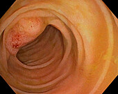 Hyperplastic colon polyp, endoscope view