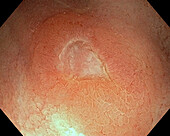 Colon ulcer in Crohn's disease, endoscope view