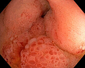 Ileitis, endoscope view