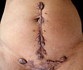 Keloid scarring after surgery