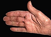Crusted scabies lesions on hand