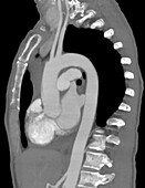 Heart and aorta, CT scan
