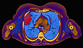 Primary adenocarcinoma lung cancer, CT scan