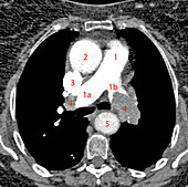 Pulmonary embolism, axial CT scan