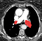 Pulmonary embolism, axial CT scan