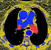 Pulmonary embolism, axial CT scan