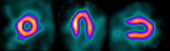 Healthy heart, SPECT scans