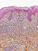 Skin lymphocytes in secondary syphilis, light micrograph
