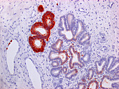 Cervical cancer, light micrograph