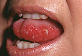 Aphthous ulcer
