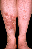Diabetic skin lesions