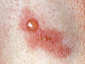 Pemphigus vulgaris lesions