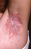 Seborrhoeic pemphigus lesions
