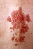 Pemphigus vulgaris lesions