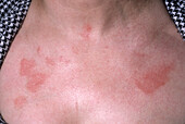 Allergic contact dermatitis