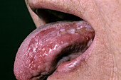 Oral erosive lichen planus