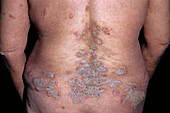 Seborrhoeic pemphigus lesions