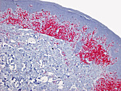 Sezary syndrome, light micrograph