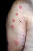 Pediculosis