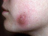 Dental abscess