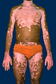 Vitiligo
