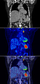 Pancreatic cancer, CT and PET scan