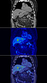 Secondary liver cancer, CT and PET scan