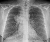 Lung cancer, X-ray