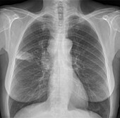 Lung cancer, X-ray